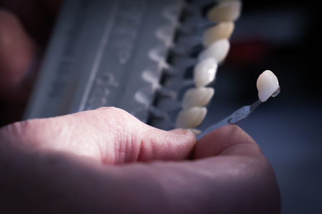 lavori odontotecnici: scelta del colore dente